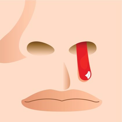 Conoce las causas y soluciones del sangrado de nariz y dolor de cabeza