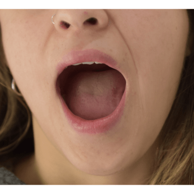 La relación entre el síntoma de mandíbula que suena y las pérdidas auditivas: lo que debes saber
