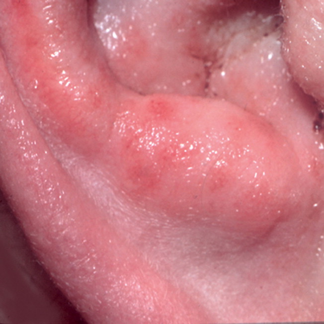 Aspiración de hongos en el oído: causas, síntomas y cómo tratarlo