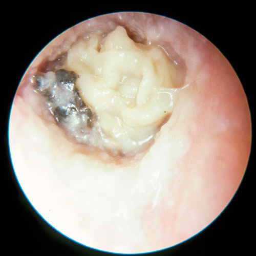 El peligro del hongo en el oído: causas, síntomas y tratamientos