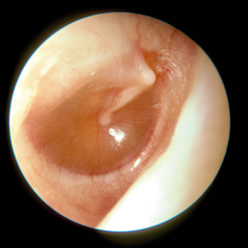 Otitis recurrente: Causas y tratamientos cuando los antibióticos no funcionan