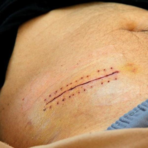 Puntos de sutura internos: cuando las heridas se hacen visibles
