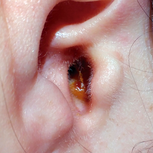Qué hacer si tienes sangrado en el oído: Todo lo que necesitas saber