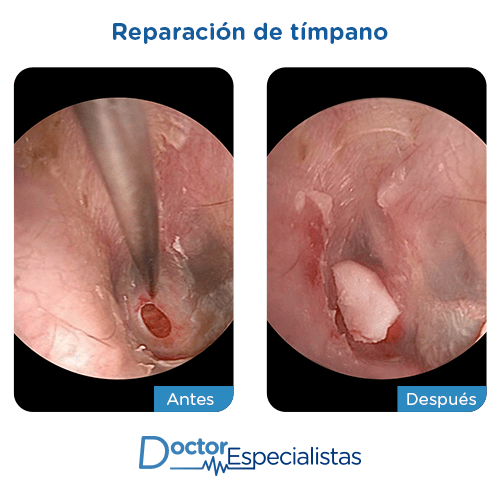 Tiempo de curación de un tímpano perforado: Todo lo que necesitas saber