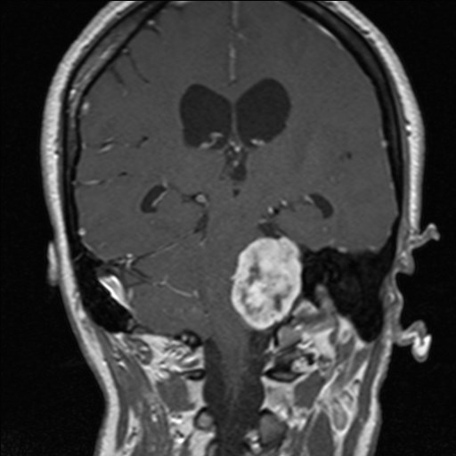 Tumor en el oído: síntomas, diagnóstico y tratamiento